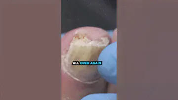 A SOLUTION for THICK NAILS?